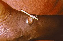 Using a matchstick to wind up and remove a Dracunculus medinensis worm from the leg of a human